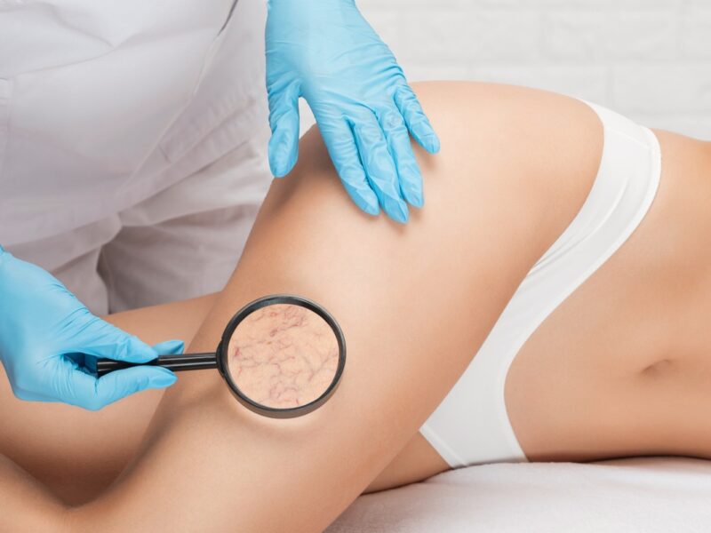 Варикоз не ждёт 40 лет!